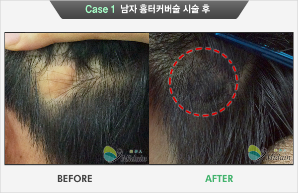 Case 1 남자 흉터커버술 시술 후(BEFORE, AFTER)