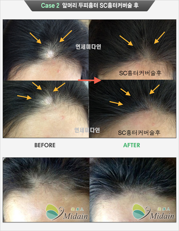 Case 2 앞머리 두피흉터 SC흉터커버술 후(BEFORE, AFTER)