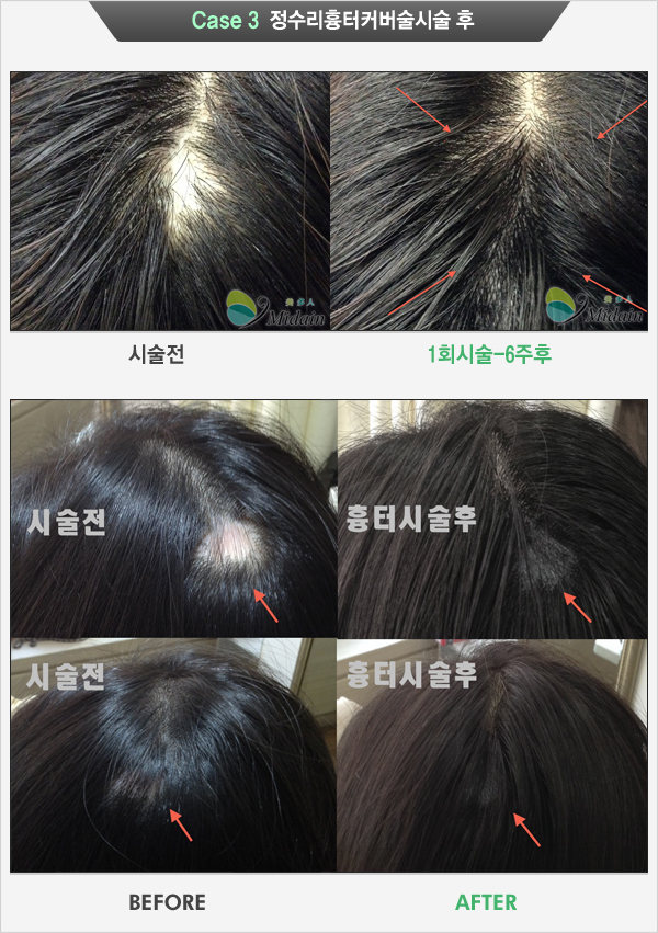 Case 3 정수리흉터커버술 시술 수(시술전, 1회시술-6주후)