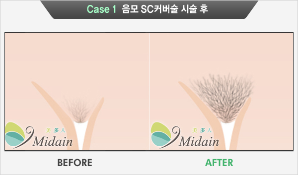 Case 1  음모 SC커버술 시술 후 (BEFORE, AFTER)