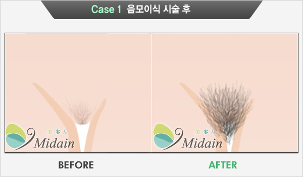 Case 1  음모이식 시술 후 (BEFORE, AFTER)