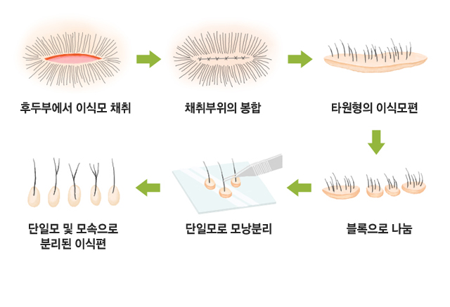후두부에서 이식모 채취→ 채취부위의 봉합→ 타원형의 이식모편→ 블록으로 나눔→ 단일모로 모낭분리→ 단일모 및 모속으로 분리된 이식편