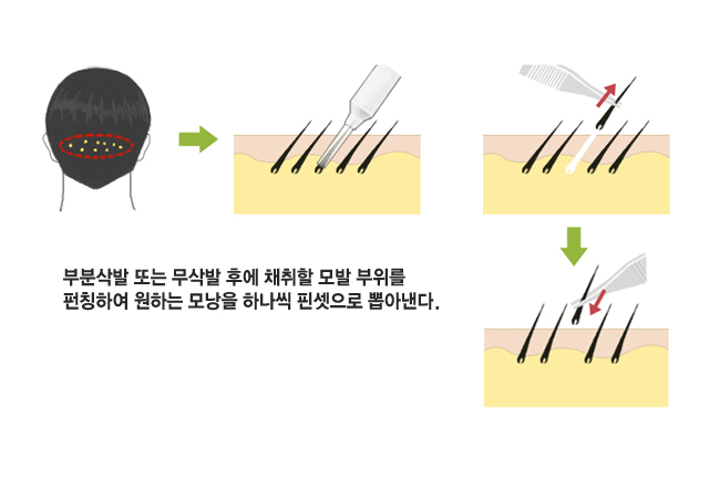 부분삭발 또는 무삭발 후에 채취할 모발 부위를 펀칭하여 원하는 모낭을 하나씩 핀셋으로 뽑아낸다.