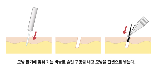 모낭 굵기에 맞춰 가는 바늘로 슬릿 구멍을 내고 모낭을 핀셋으로 넣는다.